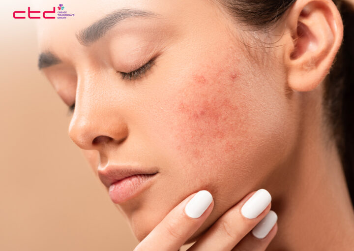 how to treat chemical burn on face from skincare