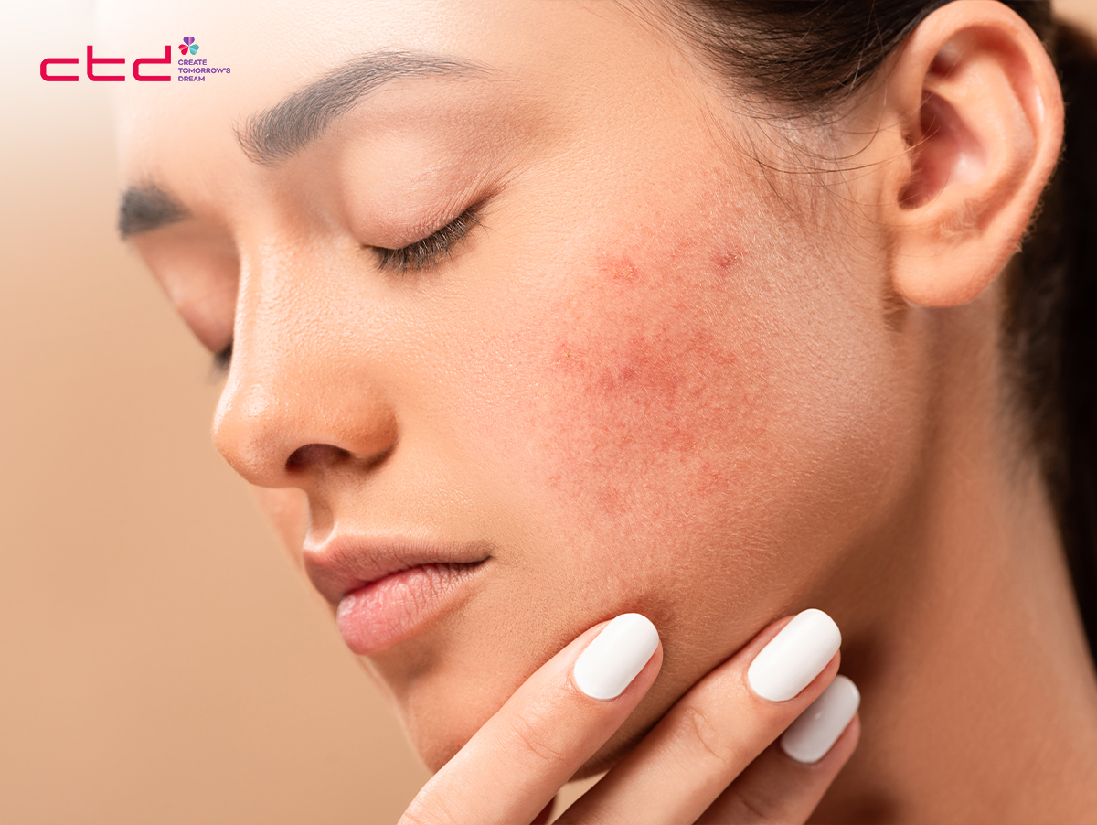 how to treat chemical burn on face from skincare