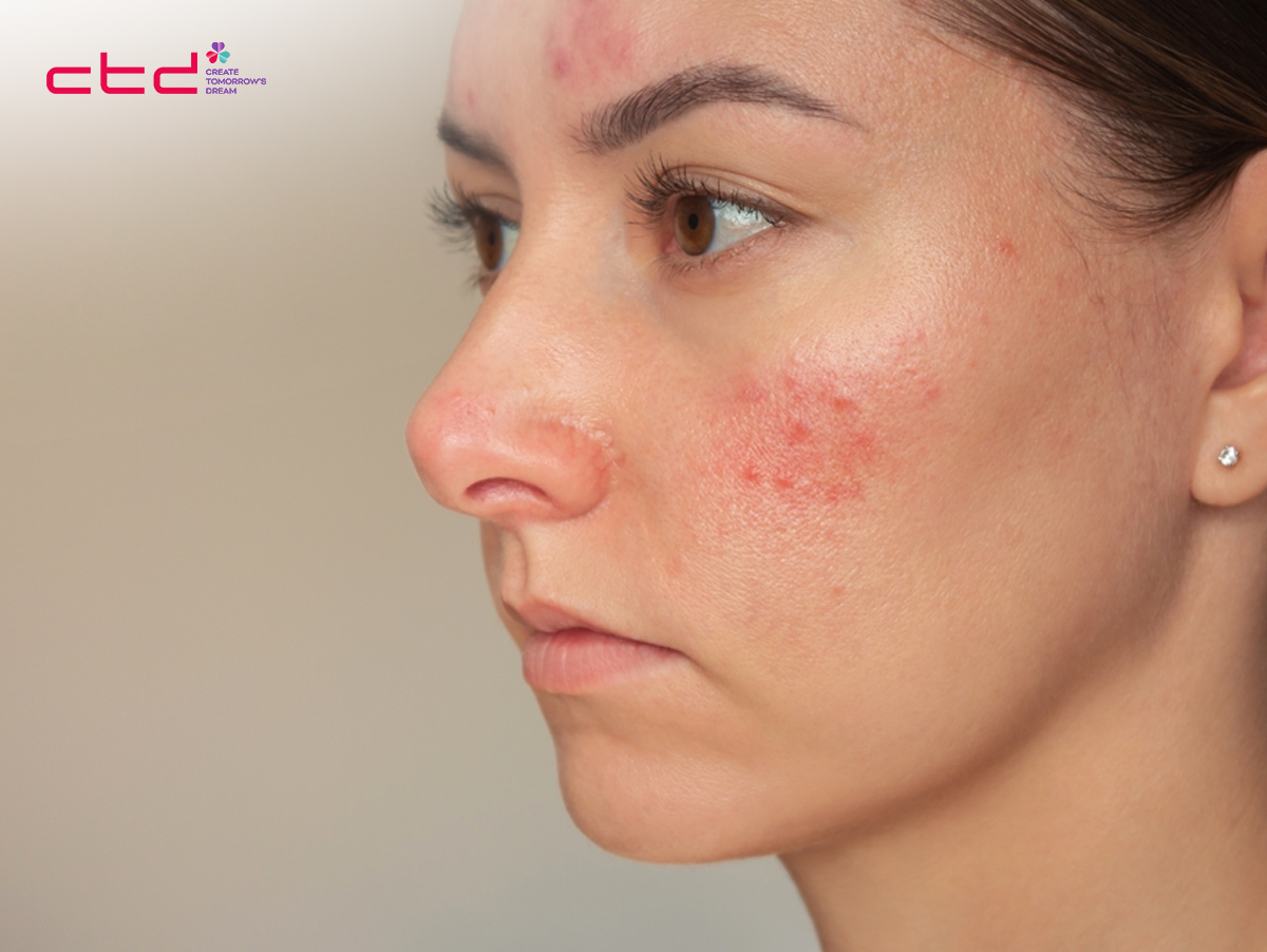 Skincare Tips for Acne Skin
